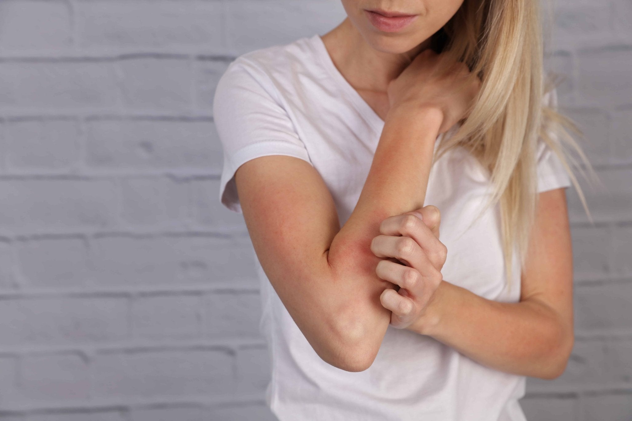 Keratosis Pilaris - behandling og effektiv creme mod Keratosis Pilaris