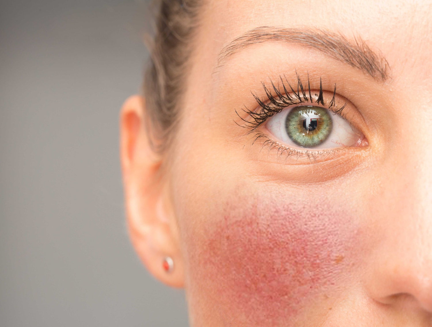 Sådan behandler og plejer du Rosacea